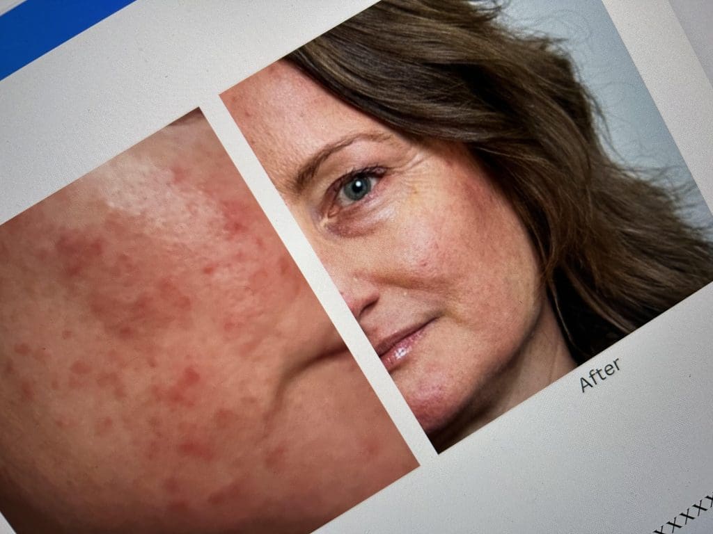 best probiotics for acne personal experience