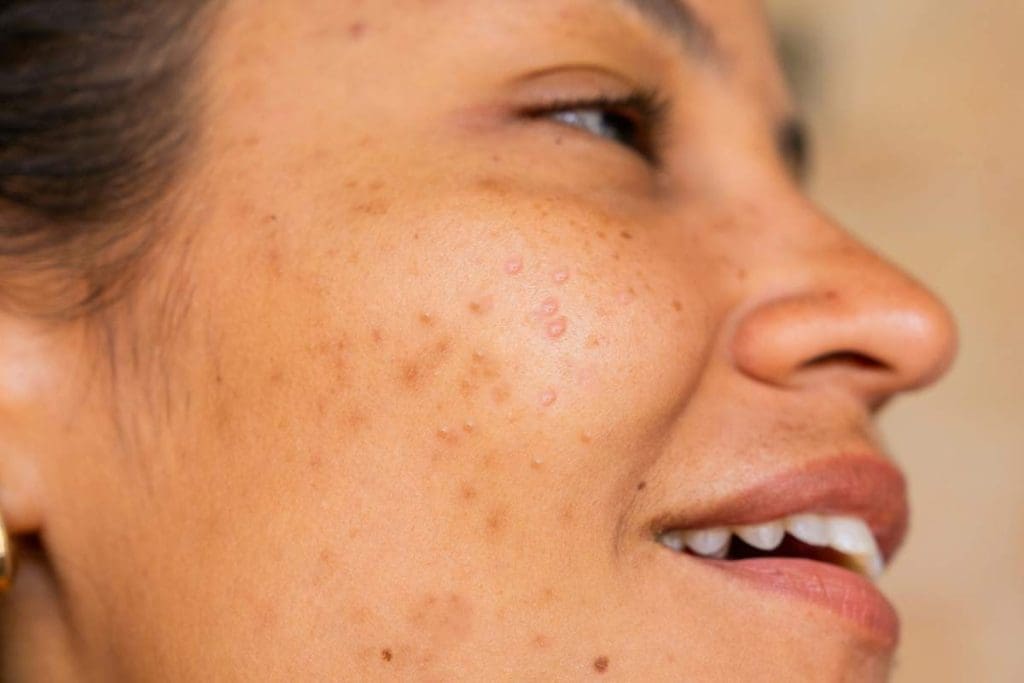 L reuteri skin and stress problems
