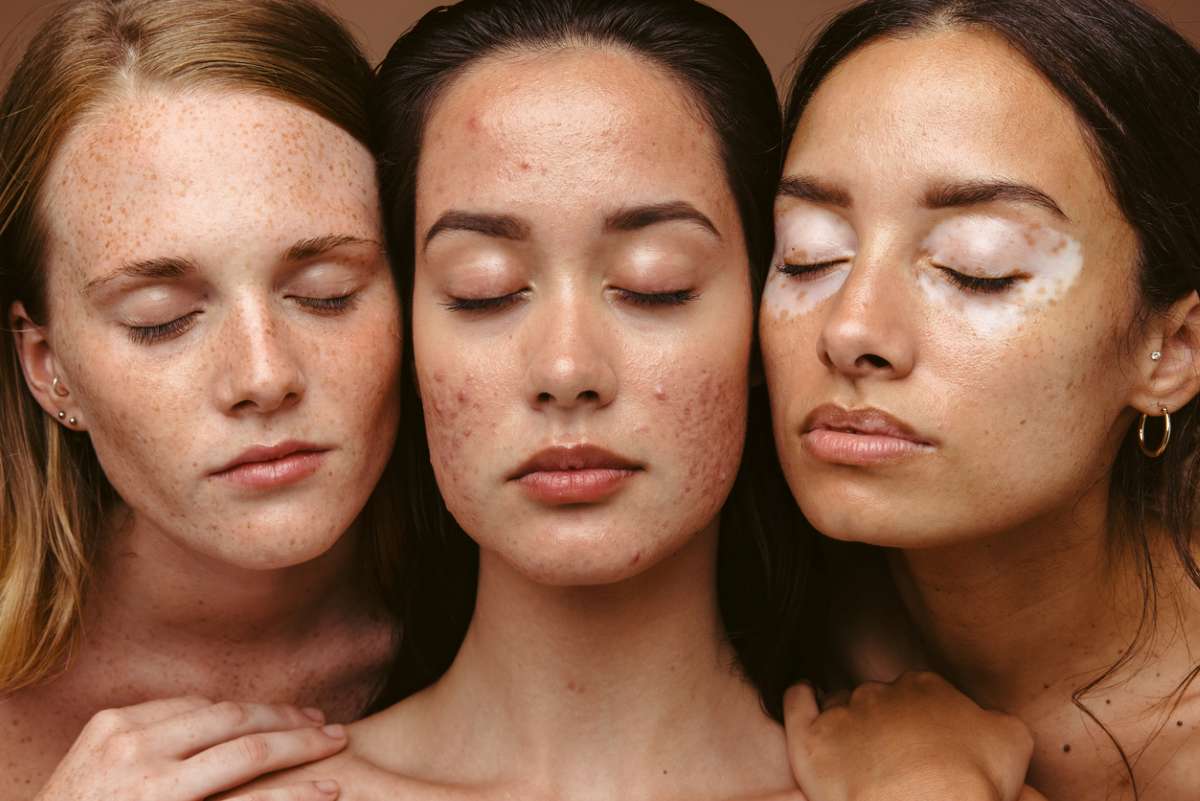 L reuteri – The secret ally againts stress and skin problems